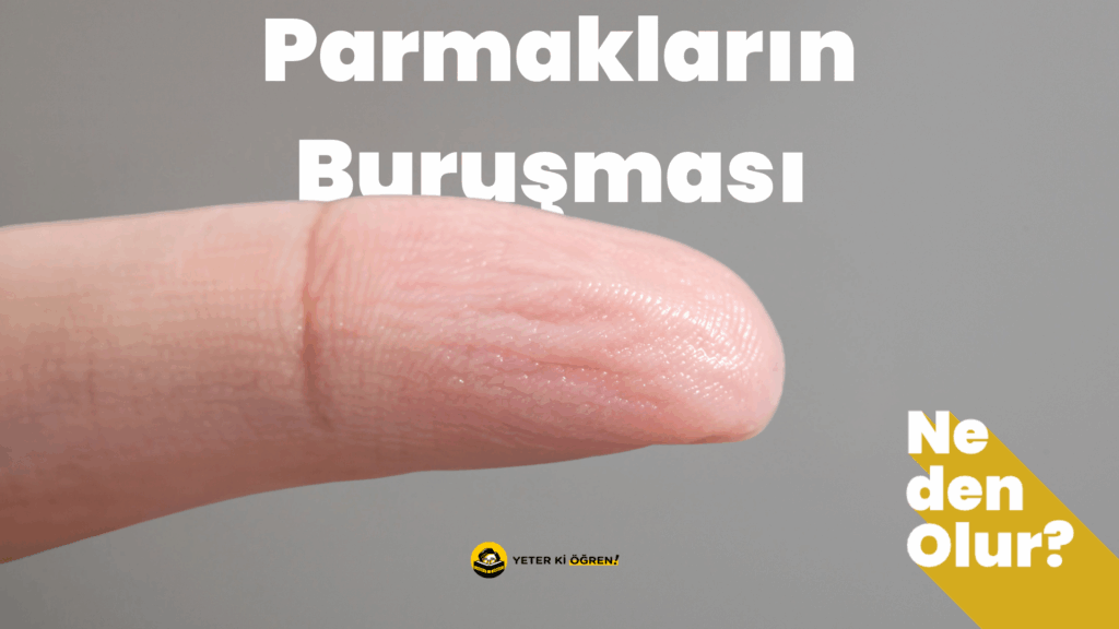 Parmak Buruşması neden olur?